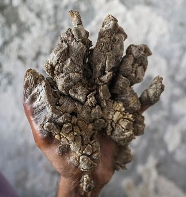 Syndróm stromového človeka desí