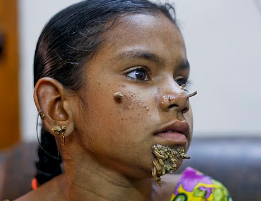 Syndróm stromového človeka desí