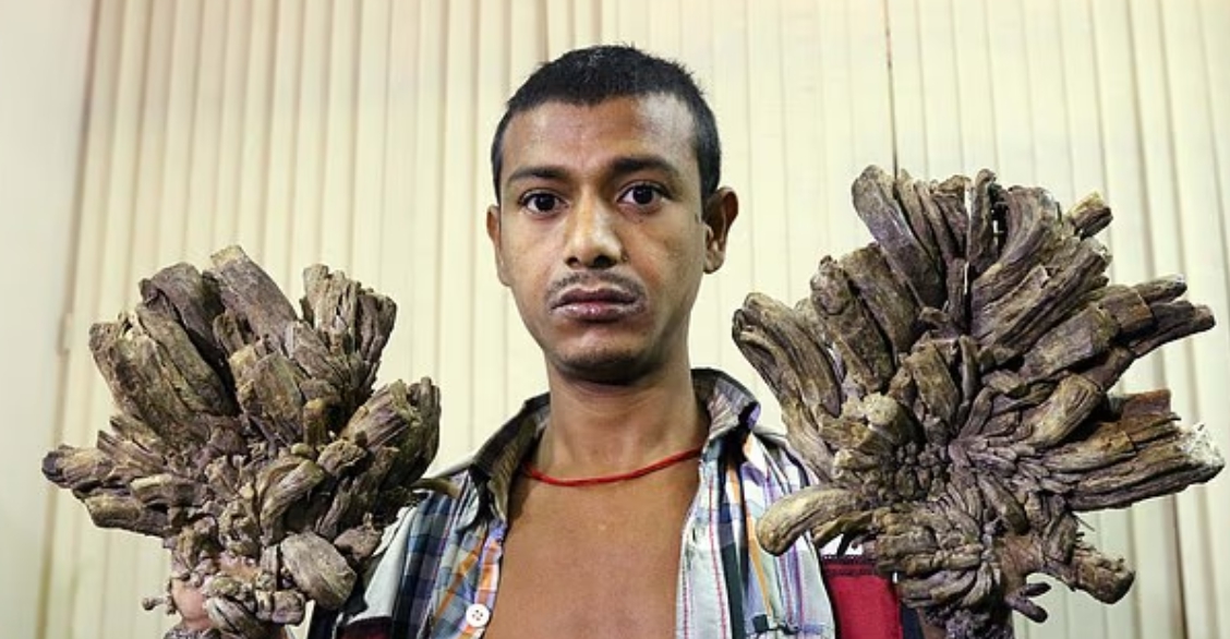 Syndróm stromového človeka desí