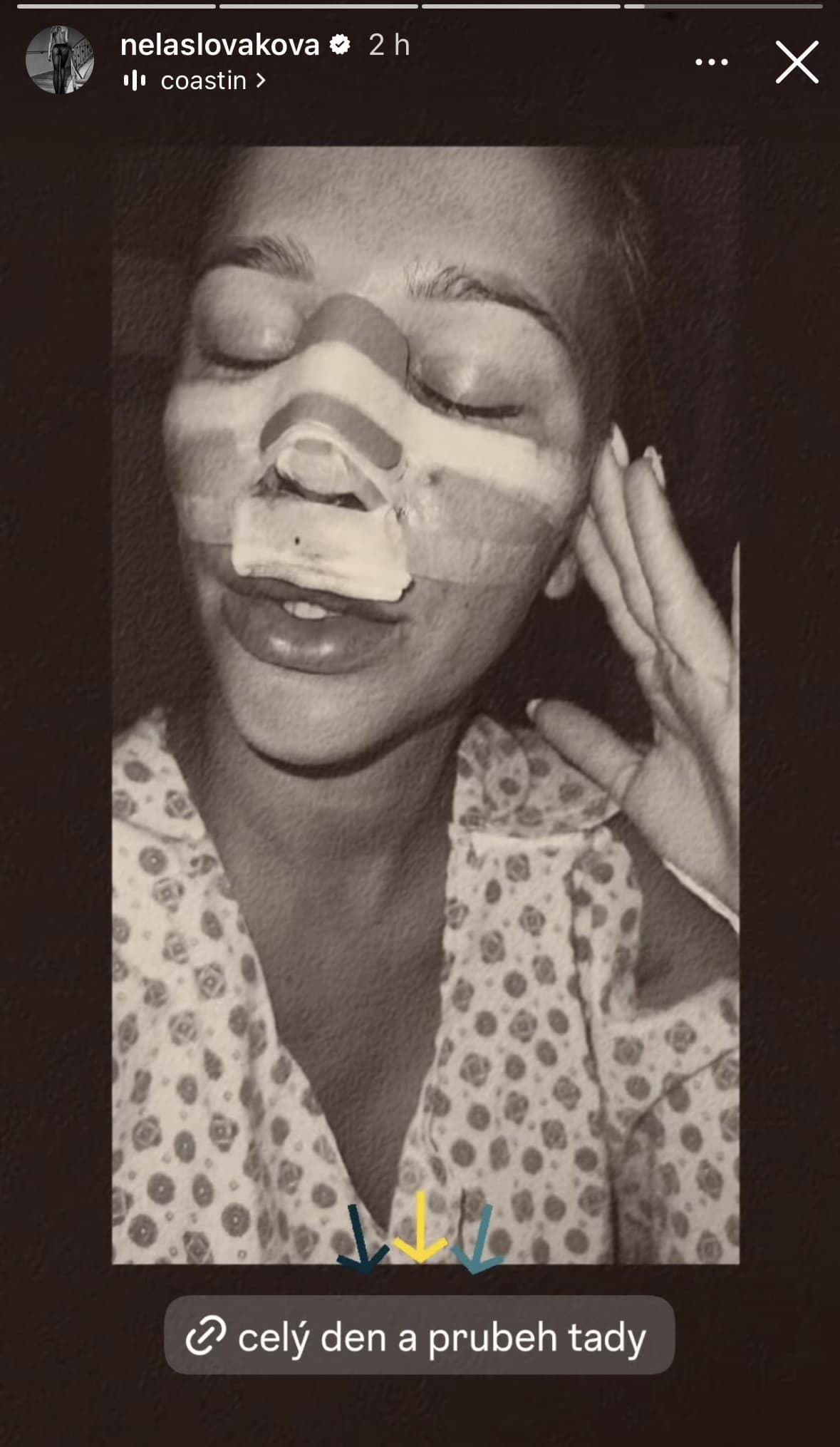 Nela Slováková podstúpila PLASTIKU: