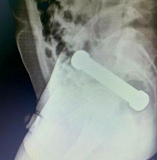 Muž si strčil činku do zadku!