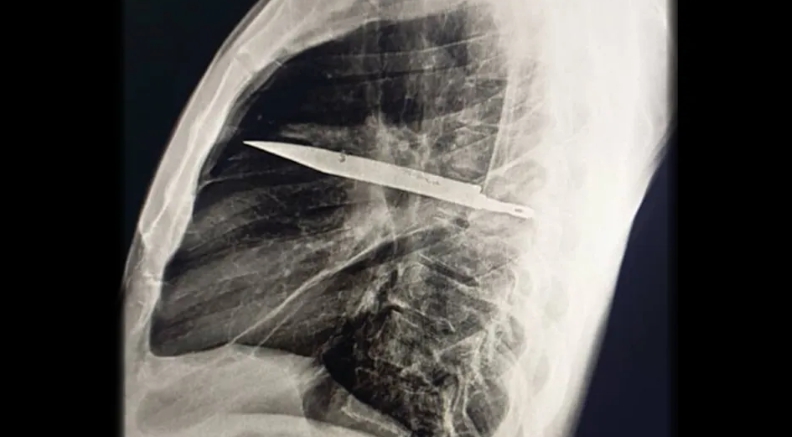 Muž žil osem rokov s nožom v hrudi bez jediného symptómu.