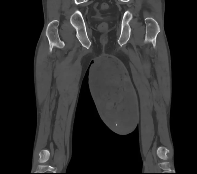 Dva roky ignoroval opuch: