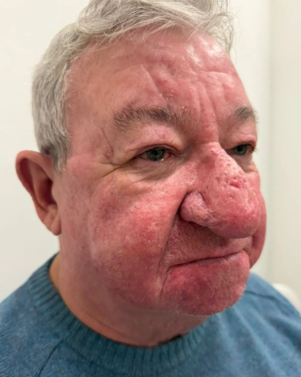 Tvár mu zdeformovalo zriedkavé ochorenie.