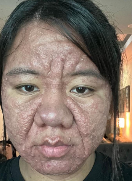 Tehotenstvo jej úplne zmenilo tvár!