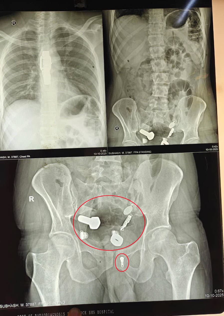 Mužovi našli v útrobách rôzne predmety.