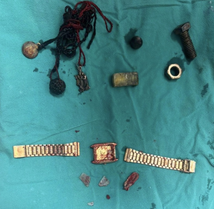 Mužovi operovali žalúdok plný kovových predmetov!