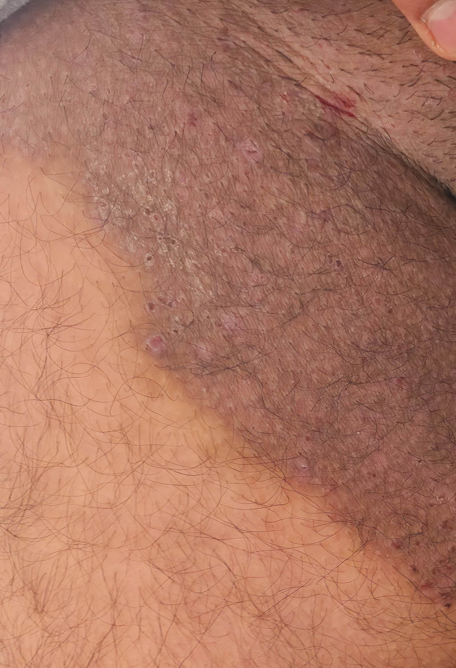 Trichophyton indotineae