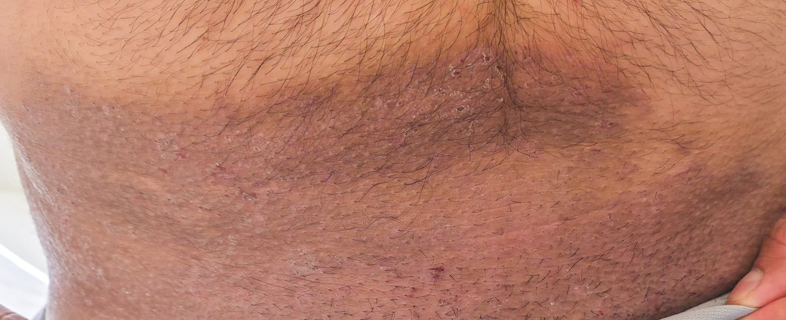 Trichophyton indotineae