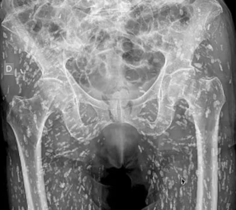 Telo mal posiate pásomnicou! 