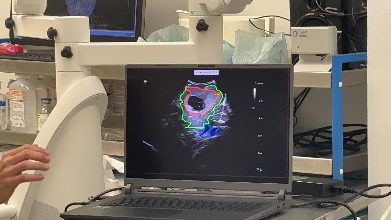 Zábery z prvej operácie mozgu asistovanej umelou inteligenciou v strednej Európe na Kramároch