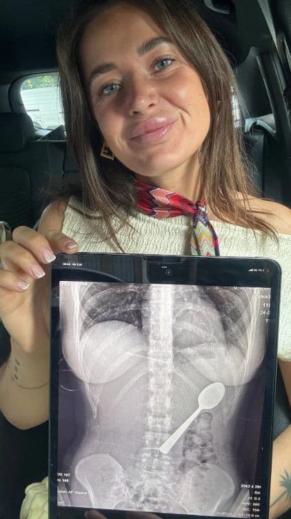 Belgičanka prehltla lyžicu.