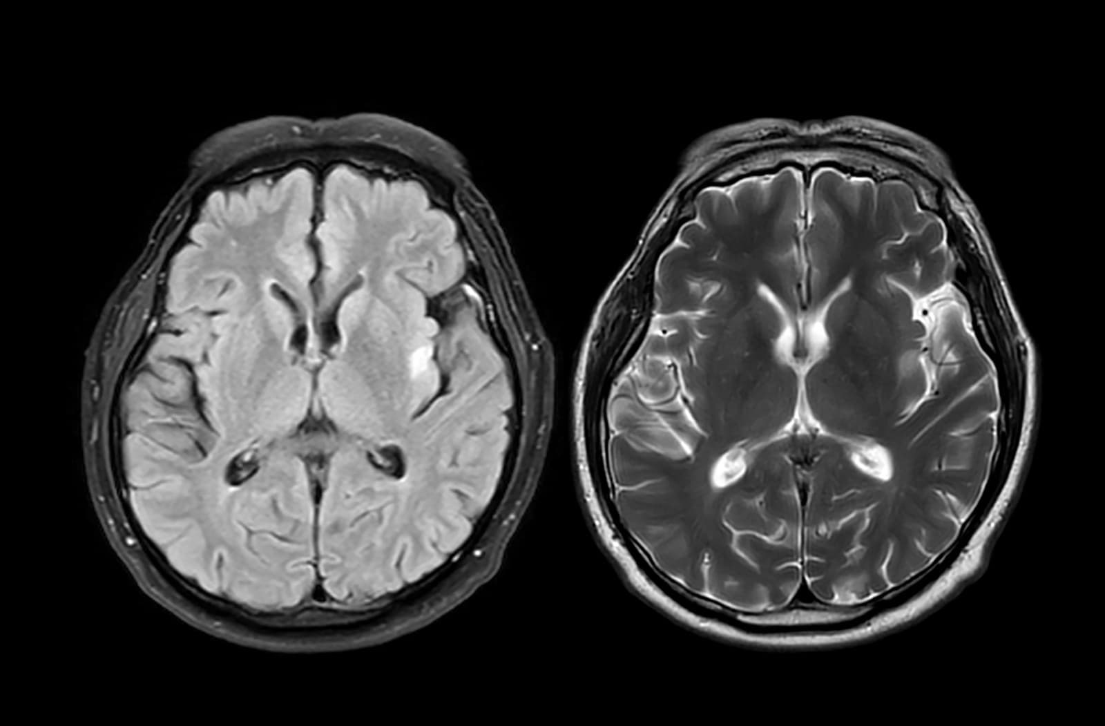 Parkinson bez trasenia? Až