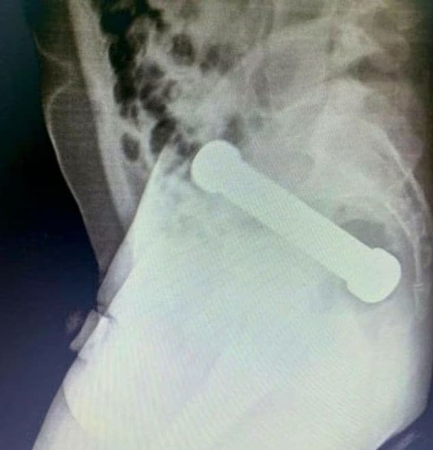 Muž mal v tele dvojkilogramovú činku.