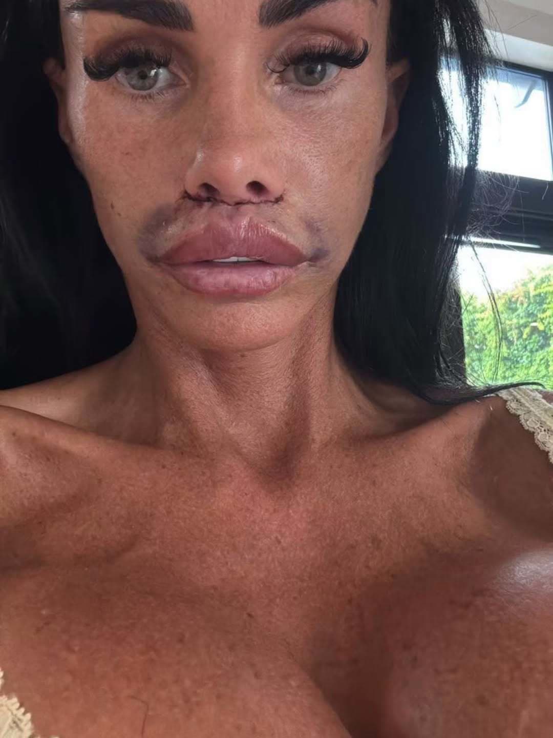 Katie Price musela pod nôž po tom, čo sa jej rozutekala výplň z pier do tváre. 