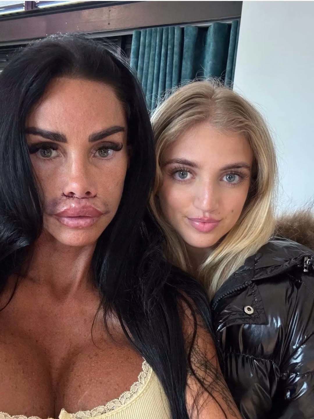 Katie Price musela pod nôž po tom, čo sa jej rozutekala výplň z pier do tváre. 