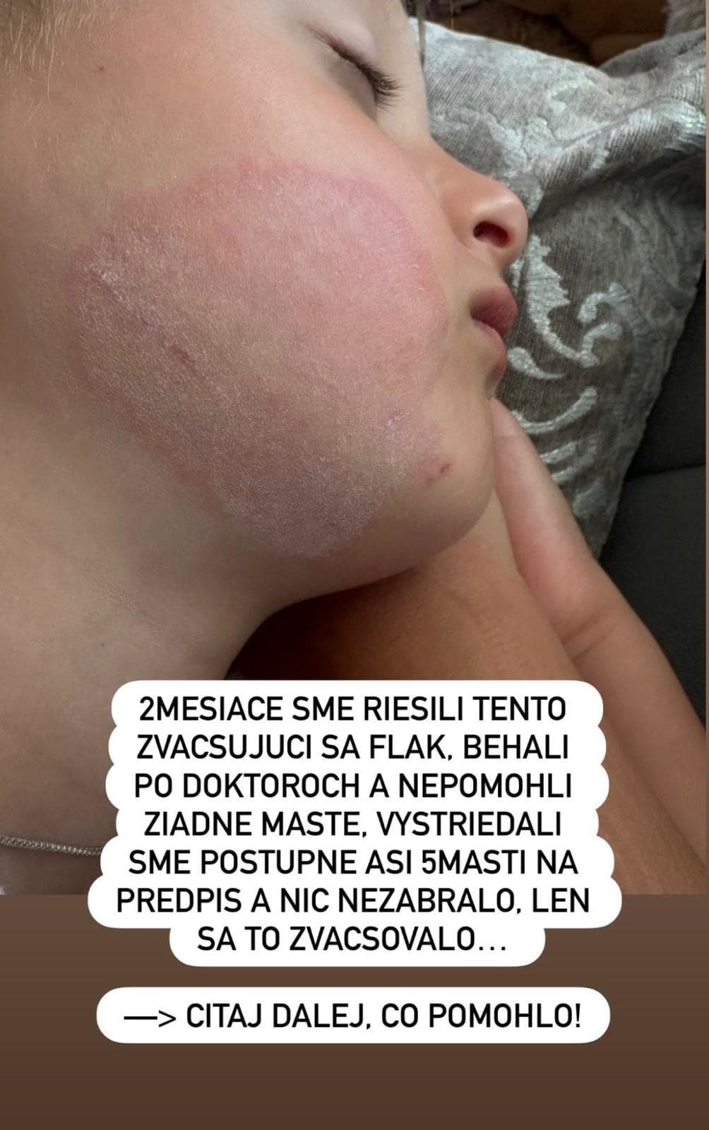 Dcéru Daniely Nízlovej trápil dva mesiaci fľak na líci. 