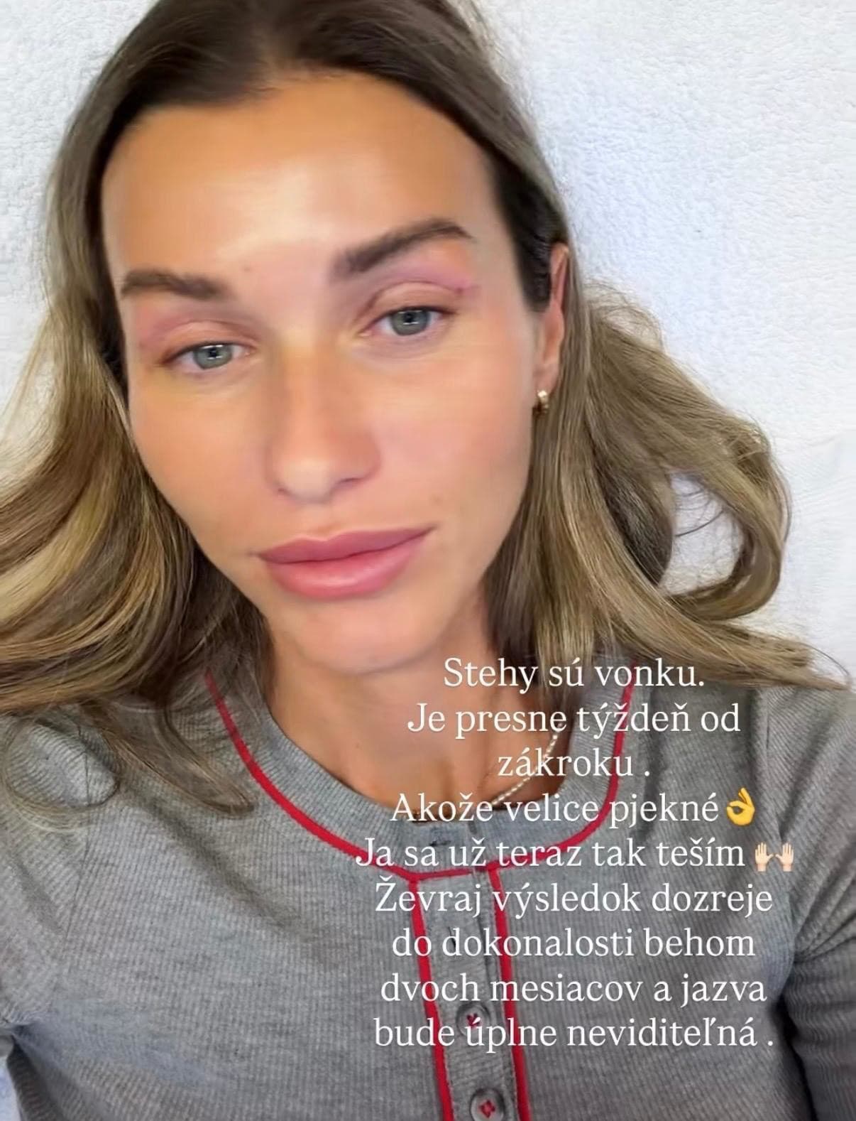 Natália Végh podstúpila estetický zákrok. 