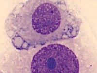 Nádorová bunka pod mikroskopom