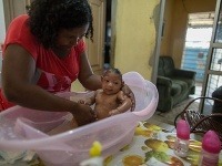 Novorodenec s deformáciou mozgu, ktorého matka sa nakazila vírusom zika Novorodenec s deformáciou mozgu, ktorého matka sa nakazila vírusom zika