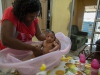 Novorodenec s deformáciou mozgu, ktorého matka sa nakazila vírusom zika