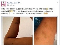 Dáša Šarközyová alias Mamba Dasha sa podelila o svoje modriny s fanúšikmi na sociálnej sieti Facebook.
