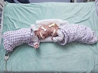 Desaťmesačné siamské dvojčatá spojené hlavami úspešne oddelili. Desaťmesačné siamské dvojčatá spojené hlavami úspešne oddelili.