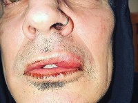 Tommy Lee zverejnil na sociálnych sieťach fotku svojej zbitej tváre. 