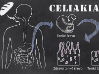 Infografika - Celiakia