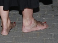Zranená noha Tereze Brodskej po pár minútach viditeľne opuchla. 