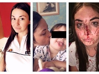 Louise Reedová (27) bola napadnutá expriateľom Louise Reedová (27) bola napadnutá expriateľom