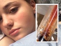 V dávkovači na kečup boli živé červy V dávkovači na kečup boli živé červy