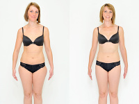 Klientka Lenka liposukciou vyriešila hneď dvojitý problém, nadbytočný tuk na bokoch špecialista využil pre doplnenie chýbajúceho objemu pŕs