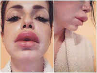 Zuzanita Žilinčíková zverejnila na Instagrame svoju znetvorenú tvár. Zuzanita Žilinčíková zverejnila na Instagrame svoju znetvorenú tvár.
