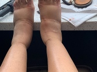 Cardi B zverejnila fotku hrozivo opuchnutých nôh. 