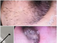 Žena mala v uchu kliešťa. Žena mala v uchu kliešťa.