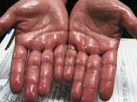 Nežiaduce účinky pri potení.