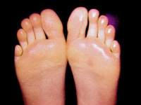 Nežiaduce účinky pri potení.