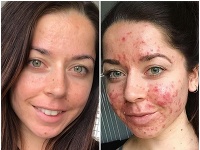 Emily Keelová dlhé roky bojovala s akné. Emily Keelová dlhé roky bojovala s akné.