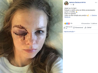 Barbora Žiačiková sa záberom bolestivého zranenia podelila na sociálnej sieti Facebook.