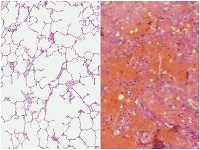 Pod mikroskopom: Vľavo pohľad na zdravé a vzdušné pľúca, vpravo rozvinutý obraz COVID-19 s úplnou deštrukciou pľúcneho tkaniva.