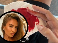 Natália Glosíková sa škaredo zranila pri otváraní konzervy. Natália Glosíková sa škaredo zranila pri otváraní konzervy.