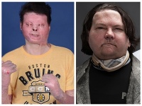 Mladý muž, ktorému transplantovali tvár, prezradil, čo počul počas kómy FOTO VIDEO