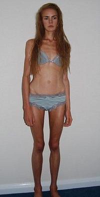Anorexia urobila z Anny vychudnutú trosku