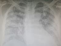 Ako vyzerajú pľúca pacienta