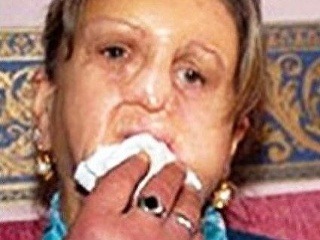 Zmrzačená žena žiada tvár