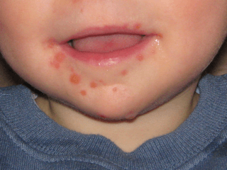 Vírusová epidémia vo Vietname