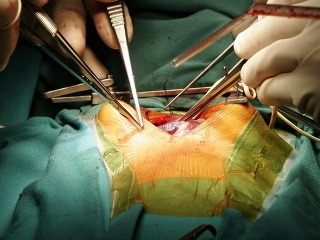 Unikátna operácia: Postrelenému dievčaťu