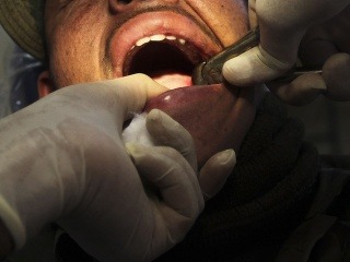 Vypadol vám trvalý zub?