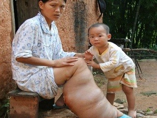 Číňanke narástla slonia noha:
